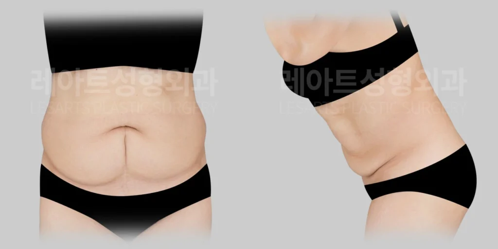복부거상 수술 전, 복부 처짐과 제왕절개 흉터 확인