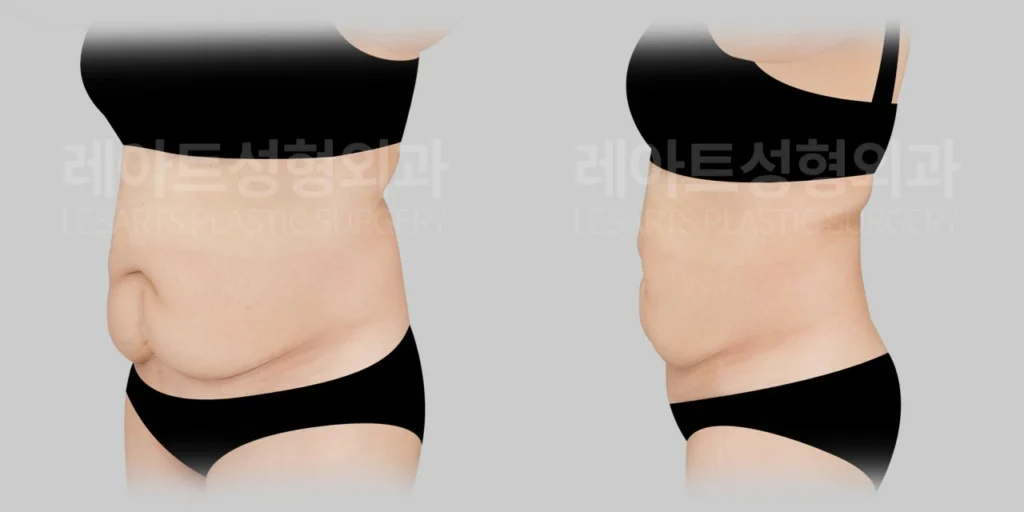 [복부거상수술 전, 복부 피부 처짐과 제왕절개 흉터를 고려한 수술 계획]