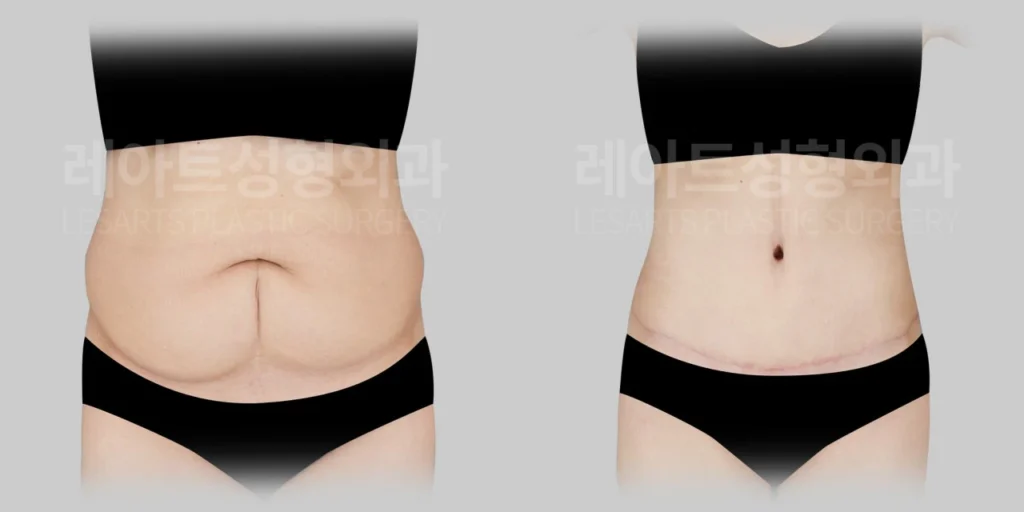 [복부거상수술 3개월 반 후, 복부 피부 처짐과 세로 흉터 변화]