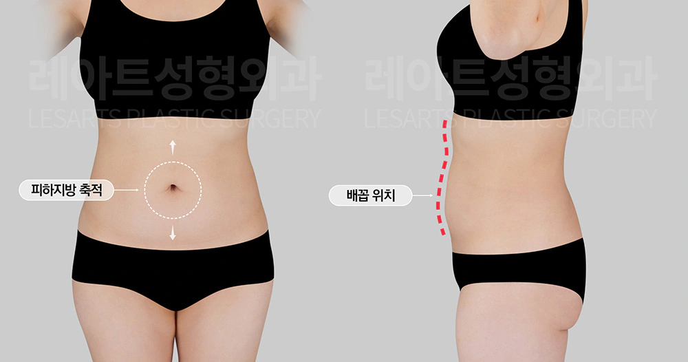 복부 형태의 특징과 지방분포 진단- 레아트 성형외과