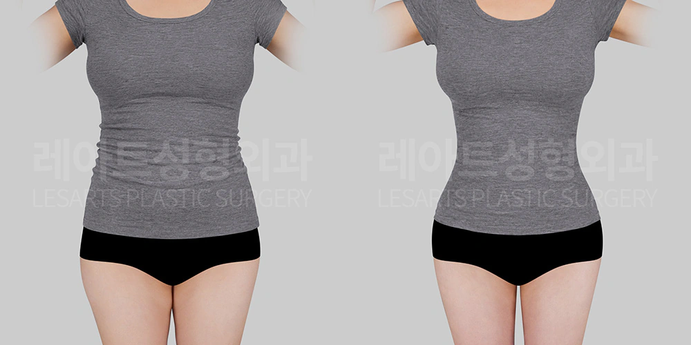 복부(앞복부, 옆구리,러브핸들) 지방흡입 ㅈ전후 - 레아트 서용승 원장