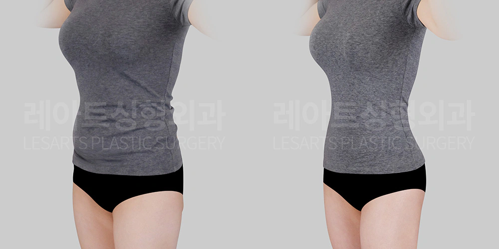 복부지방흡입, 엉덩이지방이식 2개월차 효과 - 서용승 원장