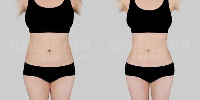 복부 지방흡입, 힙 지방이식 전후 비교 - 레아트 서용승 원장
