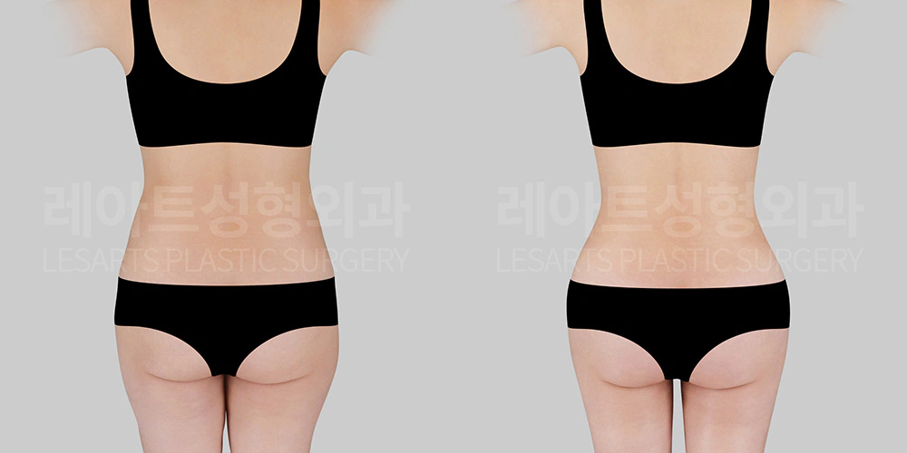 힙 지방이식 후 골반과 엉덩이 라인 변화