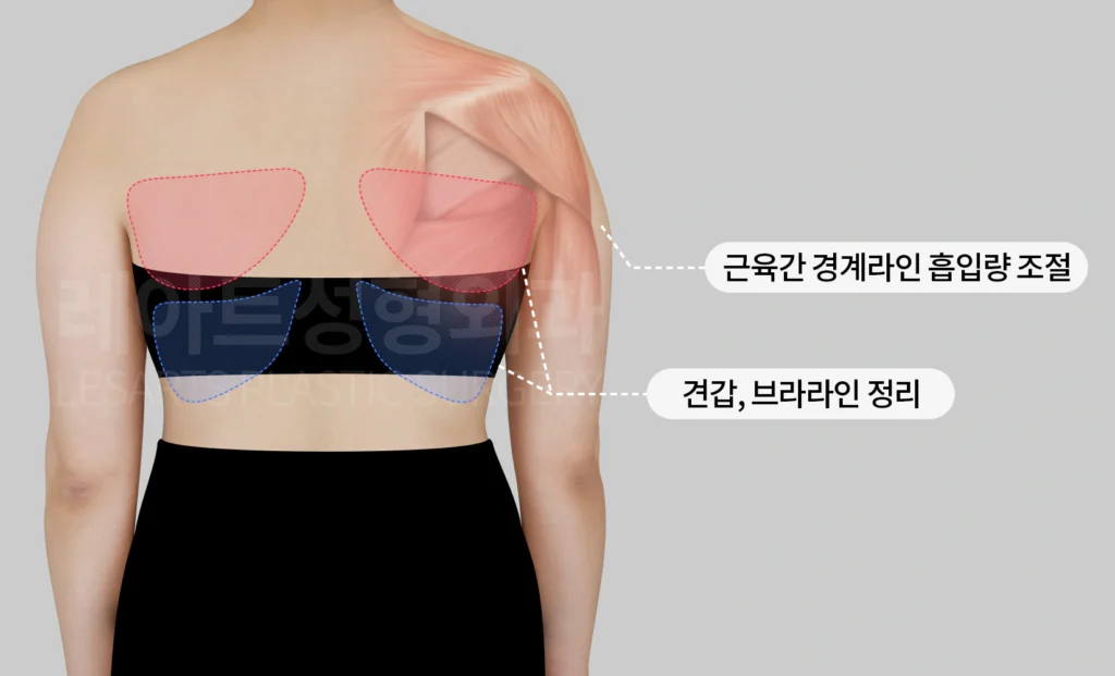 팔 지방흡입 수술 플랜