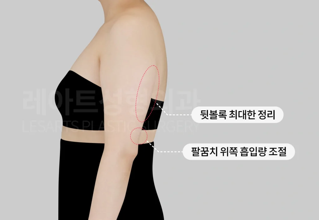 팔지방흡입 수술 전략과 디자인