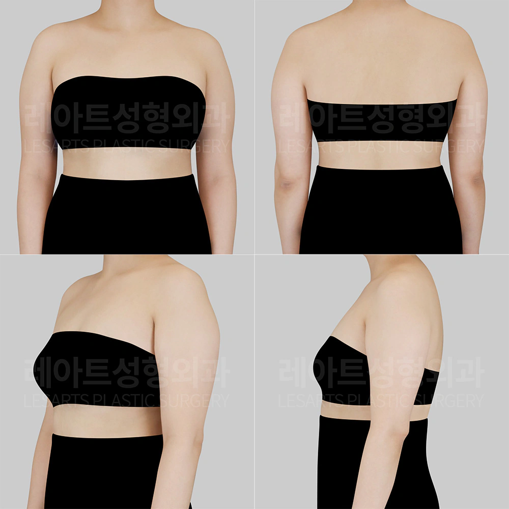 상체 지방흡입 수술 전 상태