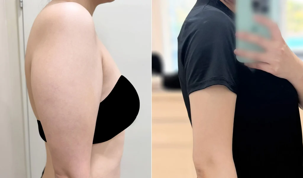 팔뚝 지방흡입 전후 비교 셀카 - 레아트 성형외과