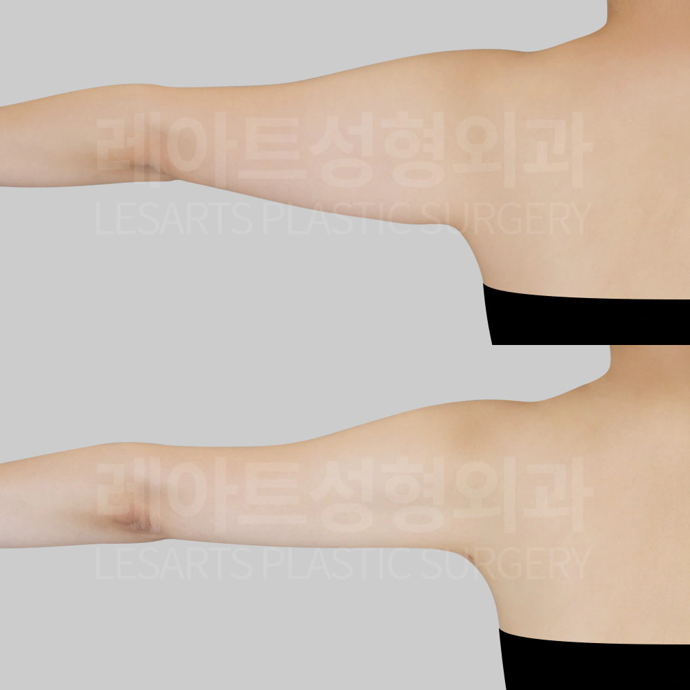 팔 지방흡입 전후 비교 - 저고리살 변화