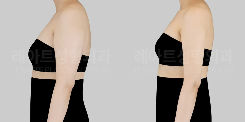 팔지방흡입 효과 - 레아트 성형외과