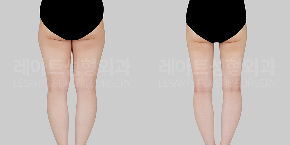 승마살 정리 후 전후 비교 - 레아트 성형외과