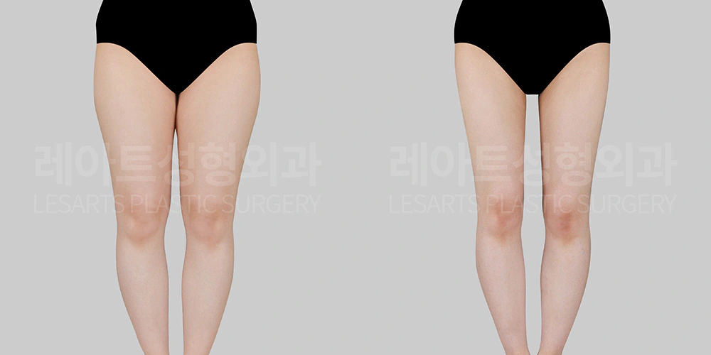 허벅지 지방흡입 전후 비교