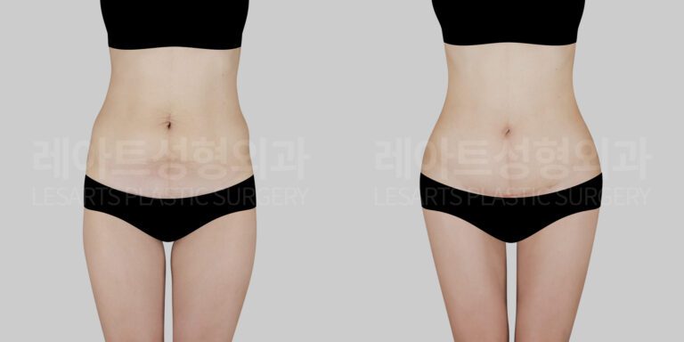 40대, 아이 둘 엄마지만 콜라병 몸매를 가질 수 있을까요? 복부 지방흡입
