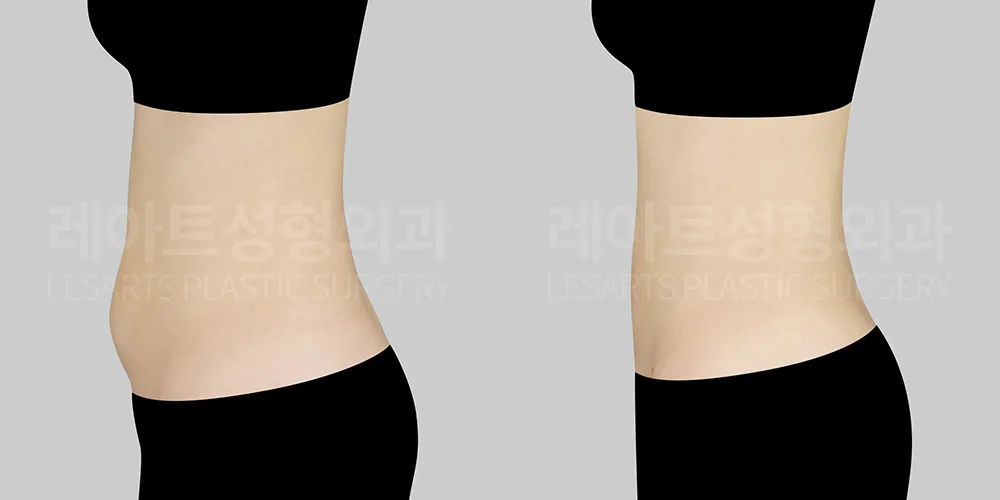 아랫배 지방흡입 전후 차이