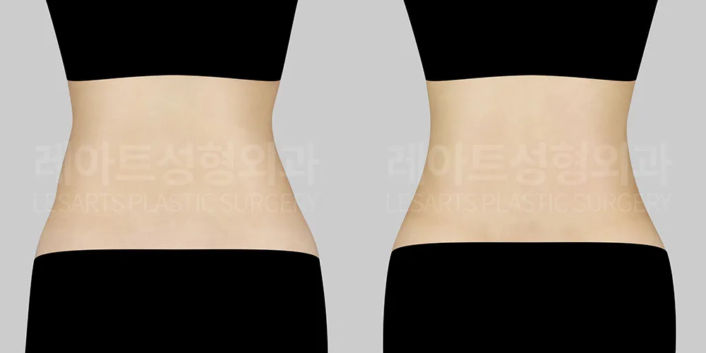 복부지방흡입 수술 후 옆구리라인 변화