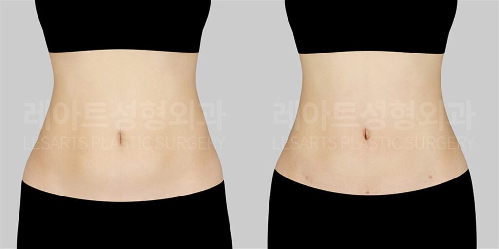 복부 지방흡입 | 아이돌 같은 예쁜 복부라인을 갖고 싶은 20대 여성, 어느 부위를 강조해야 할까? (6주 후) 전후 비교