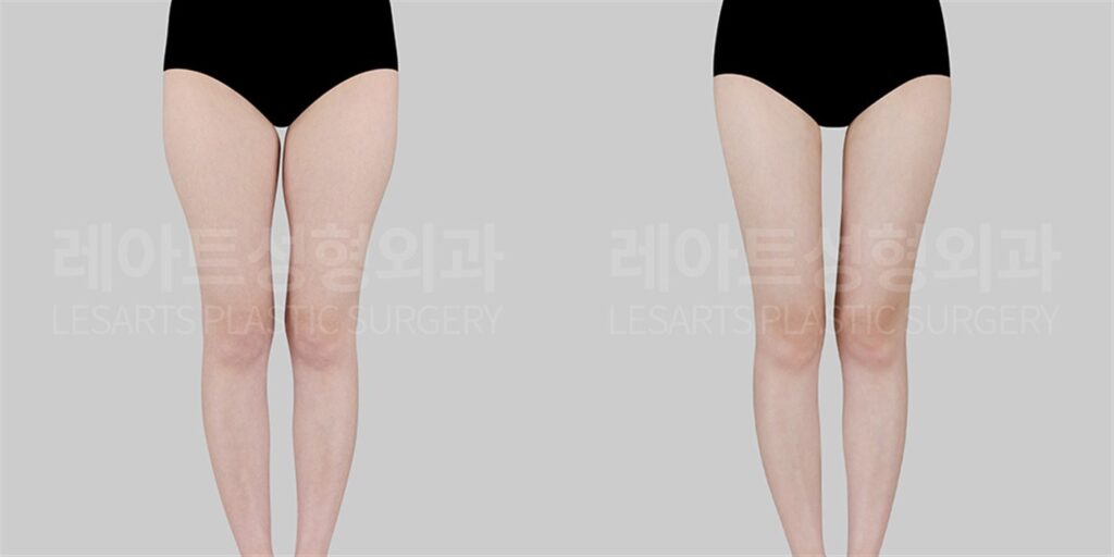 허벅지 지방흡입 | 지방이식 어디까지 해봤니? 허벅지 안쪽 일자라인의 비밀 (5개월 후) 전후 비교