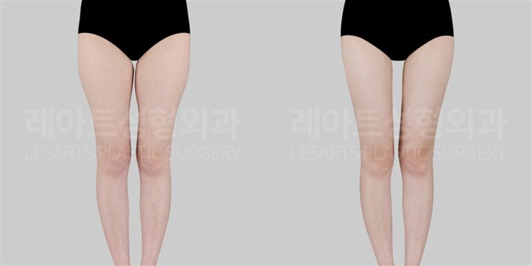 허벅지 지방흡입 | 지방이식 어디까지 해봤니? 허벅지 안쪽 일자라인의 비밀 (5개월 후) 전후 비교
