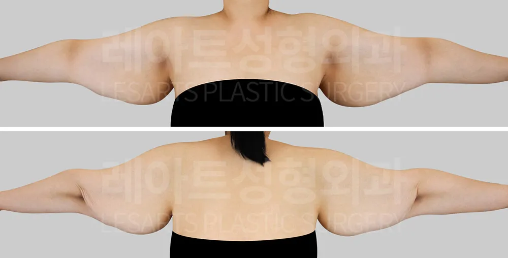 팔거상 수술 전 진단