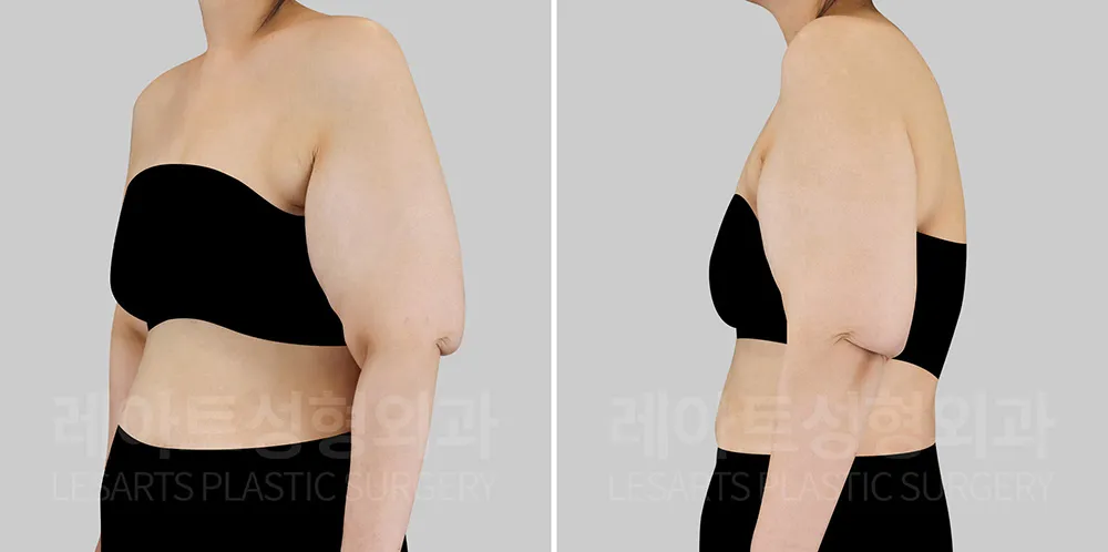 팔거상 수술 전 체형진단