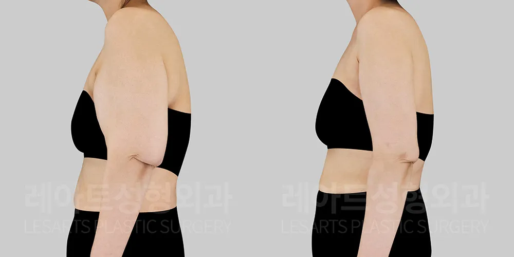팔뚝 피부 리프팅 수술 전후 비교 2개월