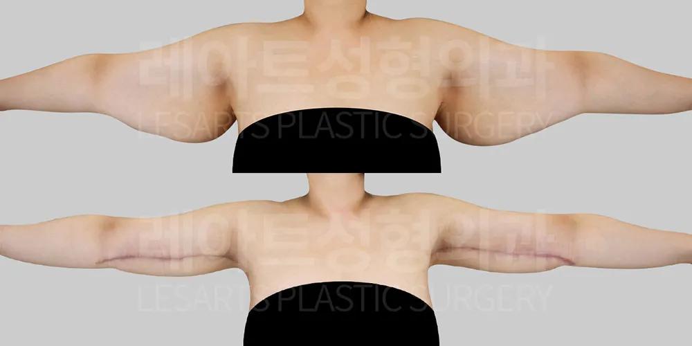 팔거상 수술 흉터 위치와 길이 2개월 차