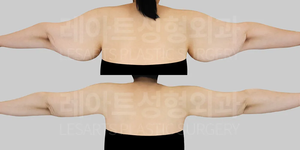 팔뚝 저고리살 처짐 해결 팔거상 2개월 경과