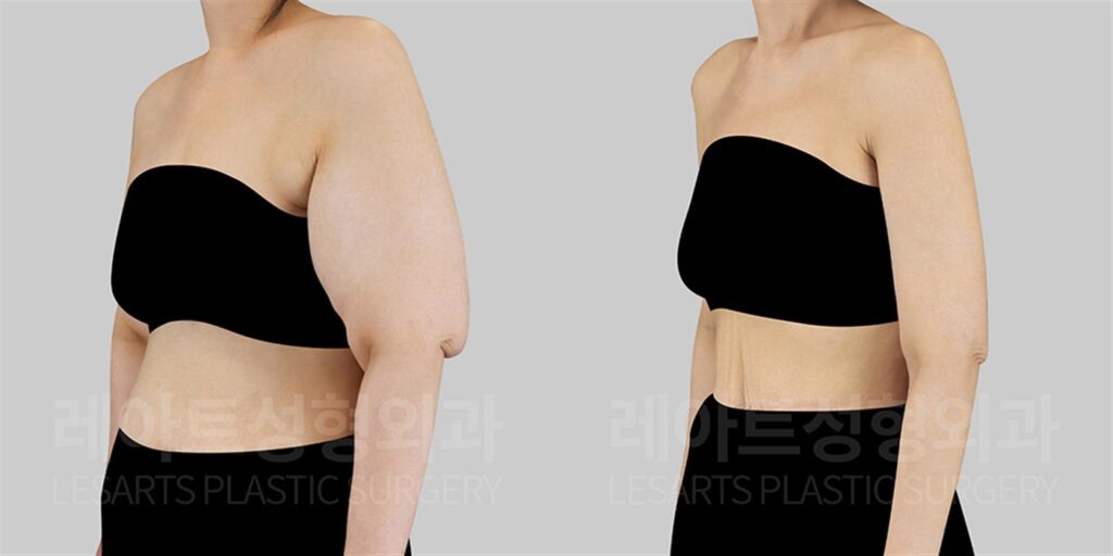 팔거상 | 체중감량 후 처진 팔뚝살 - 팔거상 수술 2~6개월 경과 (전후 비교, 흉터 상태) 전후 비교