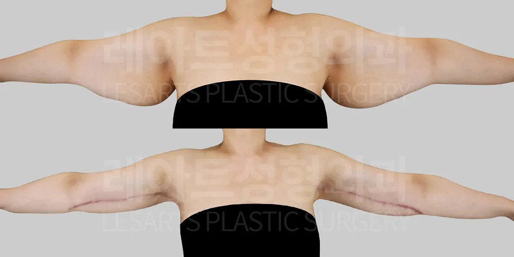 팔거상수술 3개월 차 흉터 상태