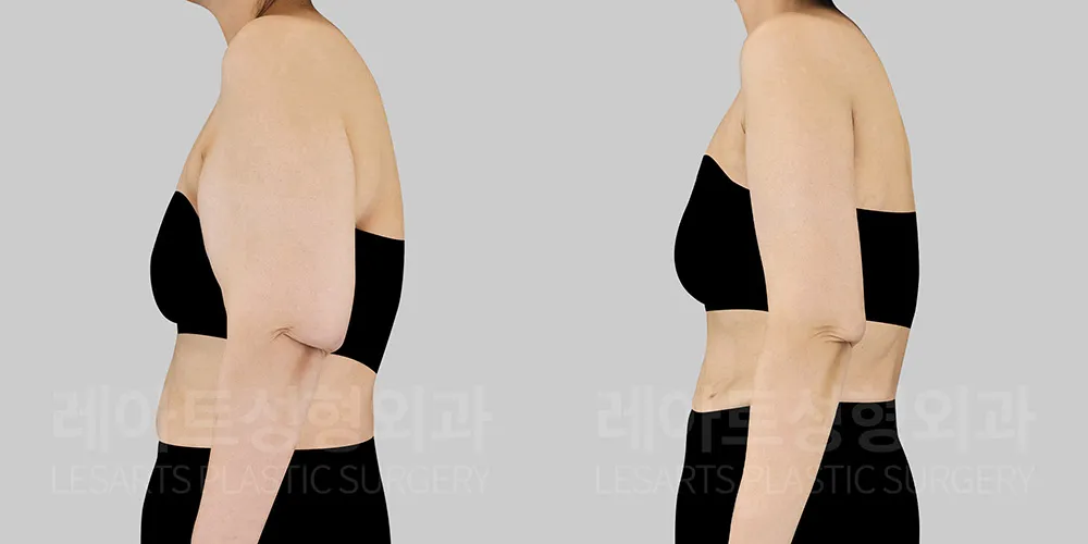 처진 팔 피부 교정 3개월 효과