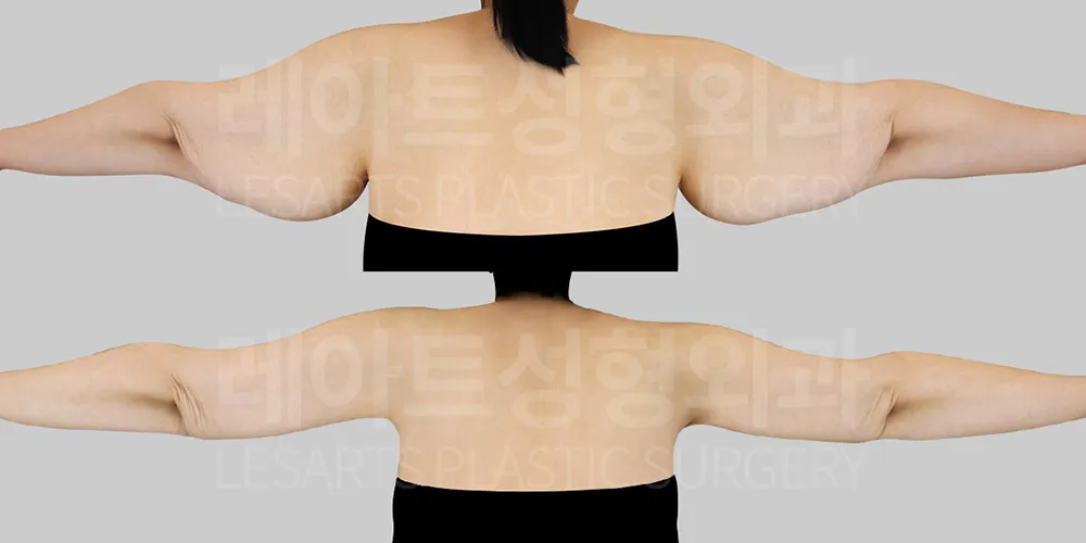 팔거상 수술 후 뒷모습 변화 3개월