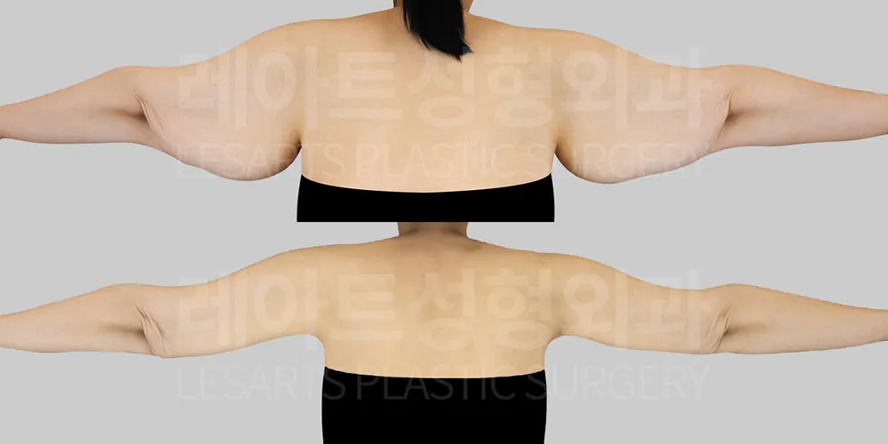 다이어트 후 팔 피부 처짐 수술 6개월 후