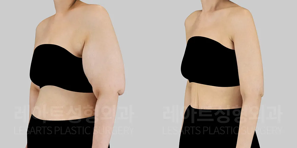 6개월 차 회복 경과 사진