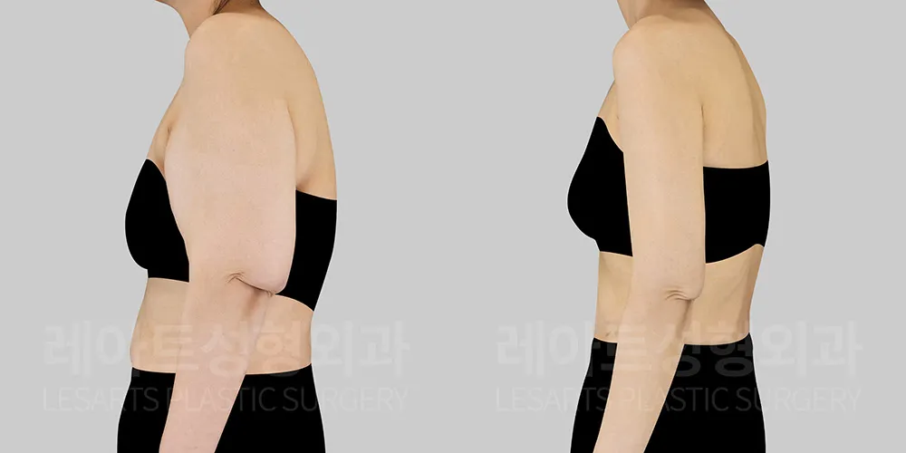 팔뚝살 처짐 수술 전후 6개월차
