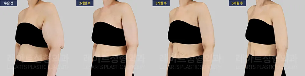 팔 지방흡입 병행 기간별 회복 상태 옆모습