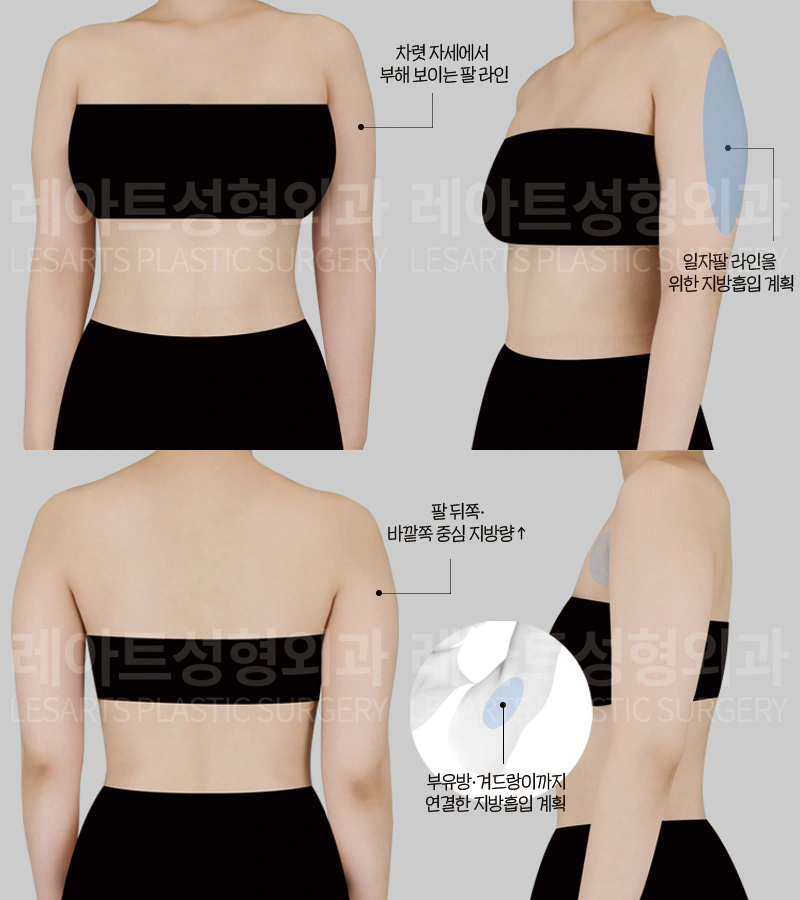 팔지방흡입 수술 전, 팔뚝 두께감과 전체 라인 상태 분석