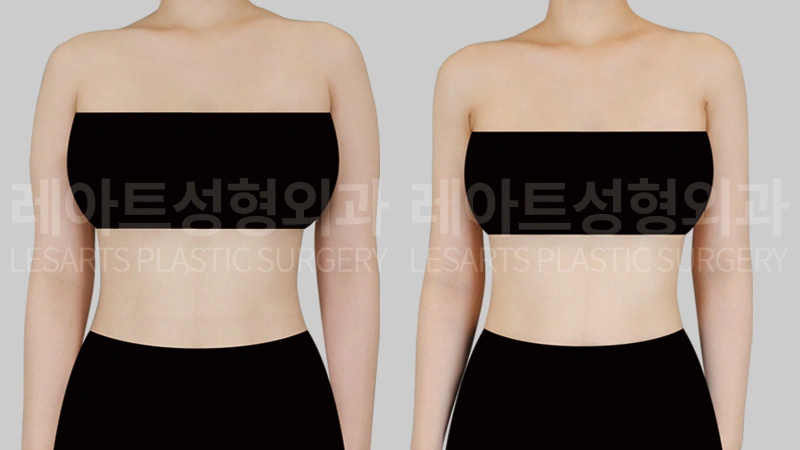 팔 지방흡입 전 후 2개월, 앞모습 일자팔 라인 비교