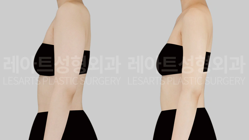 팔지방흡입 전후 2개월, 옆모습 팔 뒤쪽 두께감 비교