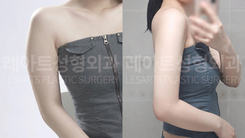 팔 지방흡입 수술 전 / 3개월 후 셀카 비교