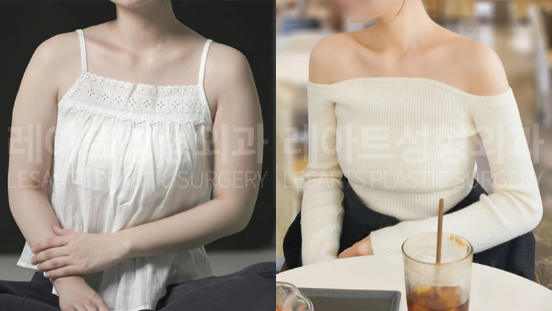 팔 지방흡입 수술 전 / 5개월 후 셀카 비교