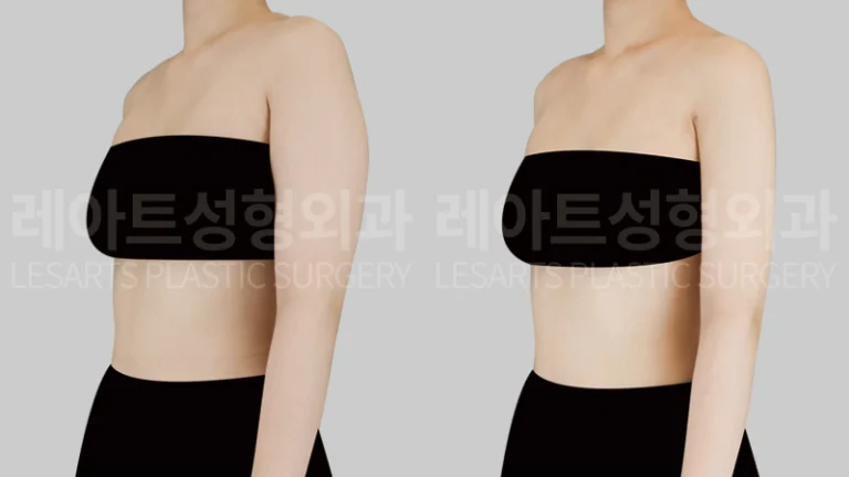 팔지방흡입 | 부유방·겨드랑이까지 정리한 2개월 후 일자팔 변화