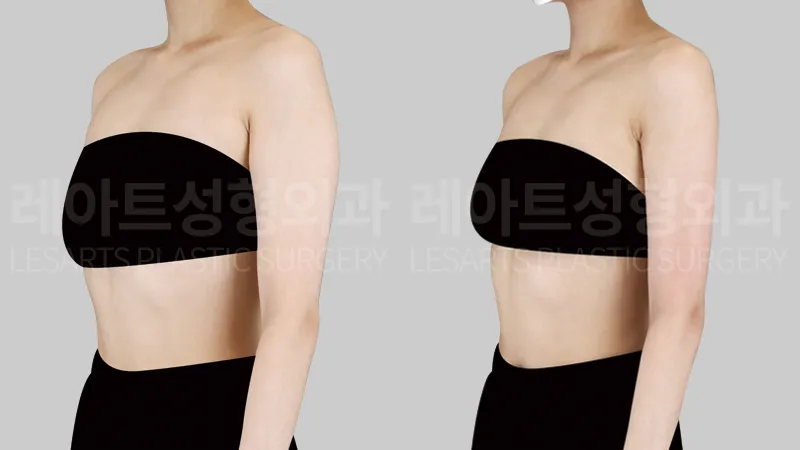 팔 지방흡입 3개월 후, 부유방에서 팔로 이어지는 바깥 라인 변화