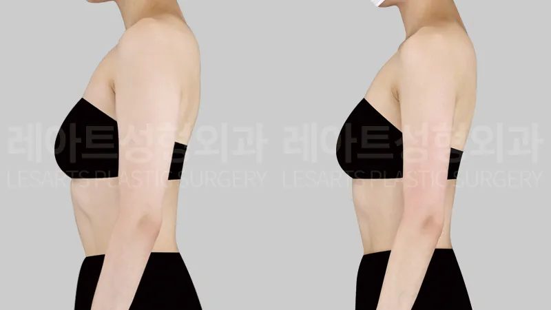 팔 지방흡입 3개월 후, 어깨 아래에서 팔꿈치까지 이어지는 뒷볼록 변화