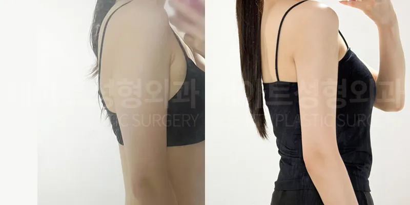 팔 지방흡입 수술 전·3개월 후 셀카 비교, 정면