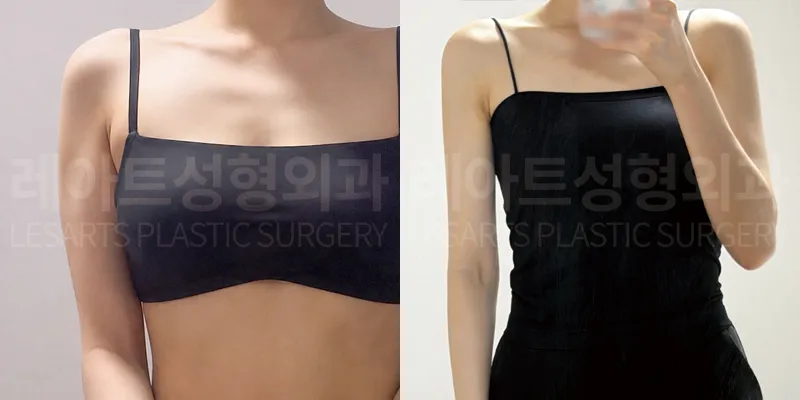 팔 지방흡입 수술 전·3개월 후 셀카 비교, 측면
