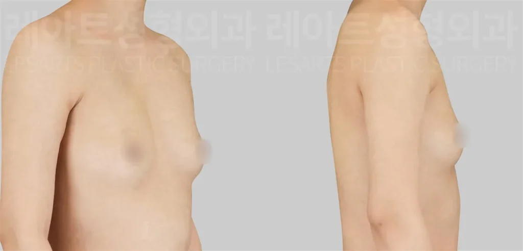 가슴지방이식 수술 전, 평평한 윗가슴과 부족한 전체 볼륨