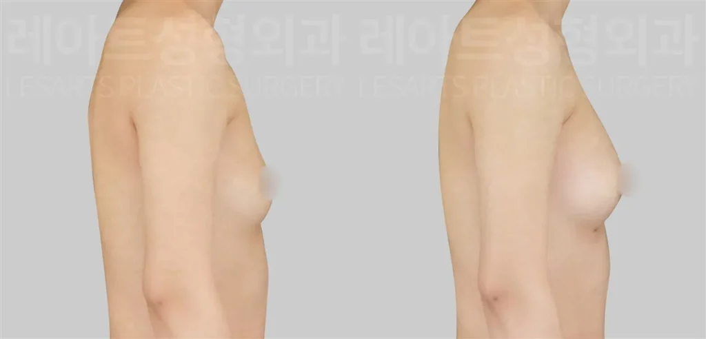 가슴지방이식 후, 가슴 높이와 자연스러운 곡선 변화