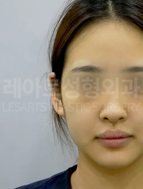 얼굴지방이식 전, 얼굴 전체 볼륨과 윤곽을 고려한 수술 계획