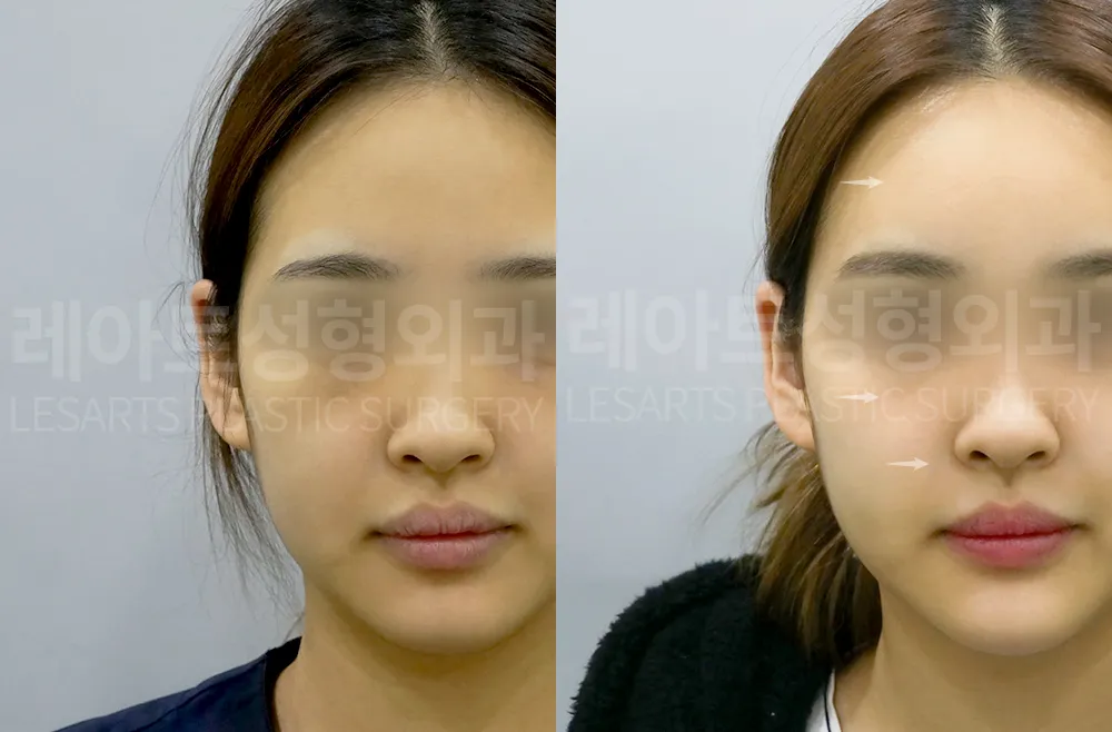 얼굴 전체 지방이식 7주 후 전후 비교