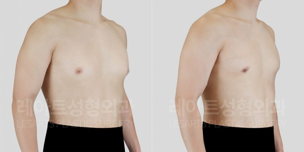 남자 여유증 수술 2개월 후, 앞가슴 돌출과 가슴라인 변화